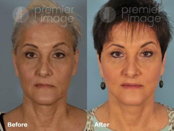 Facelift and Necklift Before and after photos in Sandy Springs, GA, Patient 15843