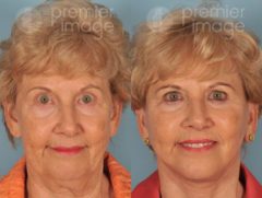 Facelift and Necklift Before and after photos in Sandy Springs, GA, Patient 15850