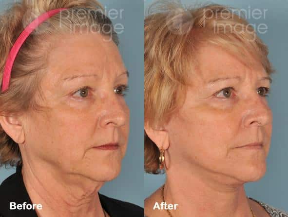 Facelift and Necklift Before and after photos in Sandy Springs, GA, Patient 15859