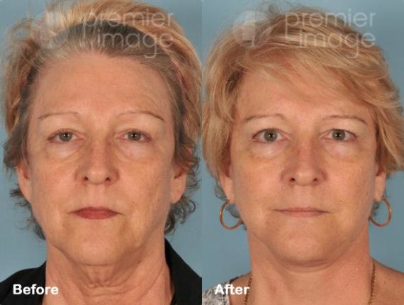 Facelift and Necklift Before and after photos in Sandy Springs, GA, Patient 15859