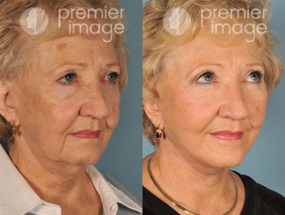 Facelift and Necklift Before and after photos in Sandy Springs, GA, Patient 15866