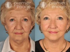 Facelift and Necklift Before and after photos in Sandy Springs, GA, Patient 15866