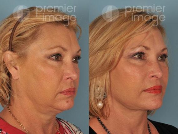 Facelift and Necklift Before and after photos in Sandy Springs, GA, Patient 15873