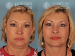 Facelift and Necklift Before and after photos in Sandy Springs, GA, Patient 15873