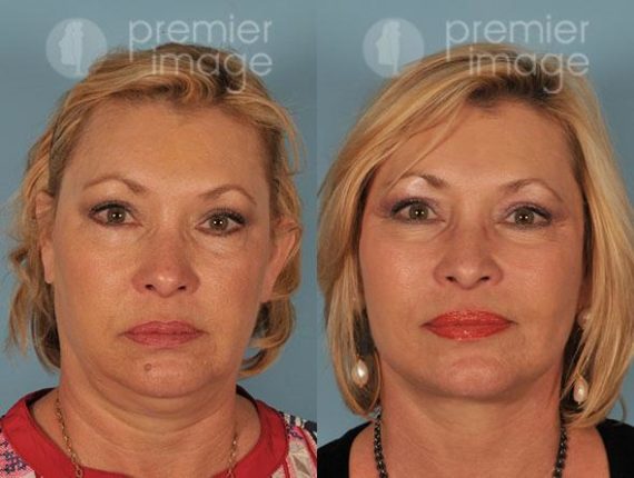 Facelift and Necklift Before and after photos in Sandy Springs, GA, Patient 15873