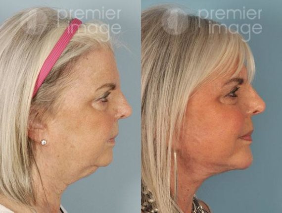 Facelift and Necklift Before and after photos in Sandy Springs, GA, Patient 15880