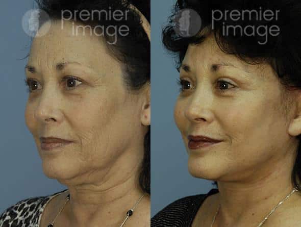 Facelift and Necklift Before and after photos in Sandy Springs, GA, Patient 15887