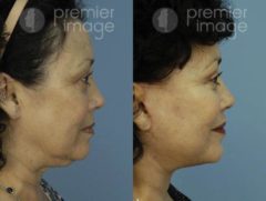 Facelift and Necklift Before and after photos in Sandy Springs, GA, Patient 15887