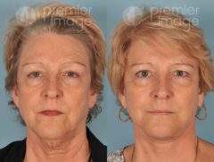 Facelift and Necklift Before and after photos in Sandy Springs, GA, Patient 15894