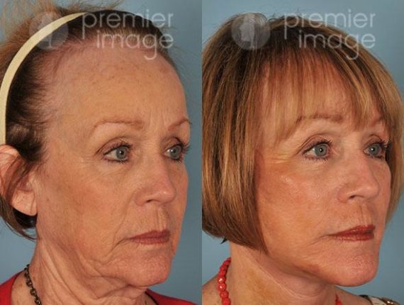 Facelift and Necklift Before and after photos in Sandy Springs, GA, Patient 15901