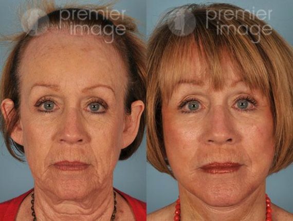 Facelift and Necklift Before and after photos in Sandy Springs, GA, Patient 15901