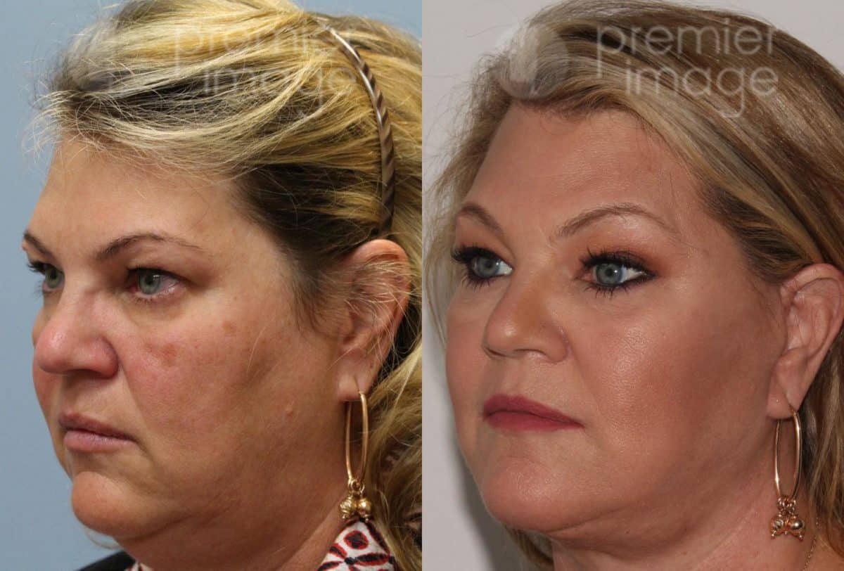 Facelift and Necklift Before and after photos in Sandy Springs, GA, Patient 15908