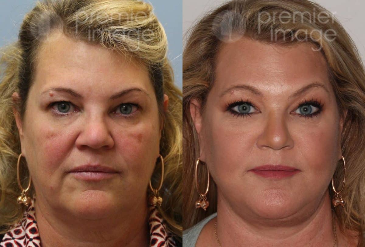 Facelift and Necklift Before and after photos in Sandy Springs, GA, Patient 15908