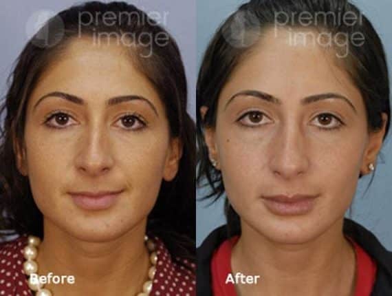 Injectables and Fillers Before and after photos in Sandy Springs, GA, Patient 15928