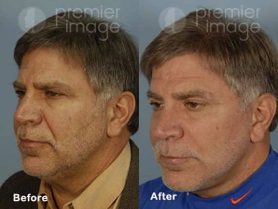 Injectables and Fillers Before and after photos in Sandy Springs, GA, Patient 15934