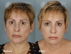 Injectables and Fillers Before and after photos in Sandy Springs, GA, Patient 15939