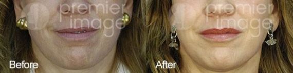 Injectables and Fillers Before and after photos in Sandy Springs, GA, Patient 15945