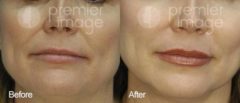 Injectables and Fillers Before and after photos in Sandy Springs, GA, Patient 15948