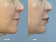 Injectables and Fillers Before and after photos in Sandy Springs, GA, Patient 15951