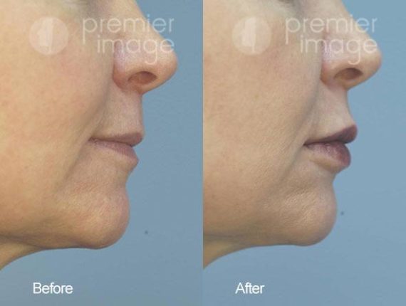 Injectables and Fillers Before and after photos in Sandy Springs, GA, Patient 15951