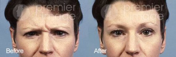 Injectables and Fillers Before and after photos in Sandy Springs, GA, Patient 15954