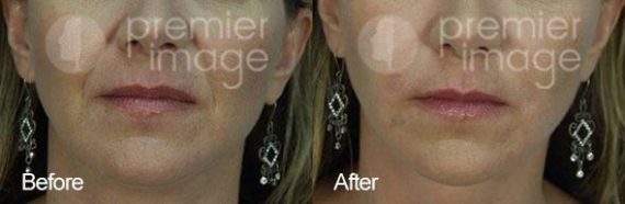 Injectables and Fillers Before and after photos in Sandy Springs, GA, Patient 15960