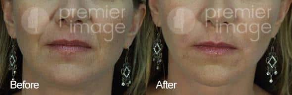 Injectables and Fillers Before and after photos in Sandy Springs, GA, Patient 15960