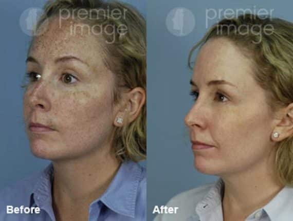 Laser Procedures Before and after photos in Sandy Springs, GA, Patient 15963