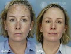 Laser Procedures Before and after photos in Sandy Springs, GA, Patient 15963