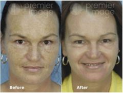 Laser Procedures Before and after photos in Sandy Springs, GA, Patient 15970