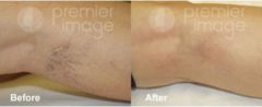 Laser Procedures Before and after photos in Sandy Springs, GA, Patient 15973