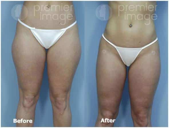 Vaser® Liposuction Before and After Photos