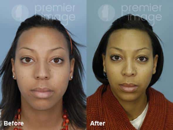  Rinoplastia Fotos Antes y Después en Sandy Springs, GA, Patient 15996