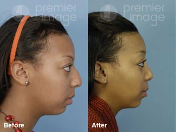 Rhinoplasty Before and after photos in Sandy Springs, GA, Patient 15996