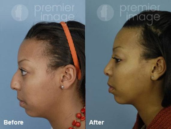 Rhinoplasty Before and after photos in Sandy Springs, GA, Patient 15996