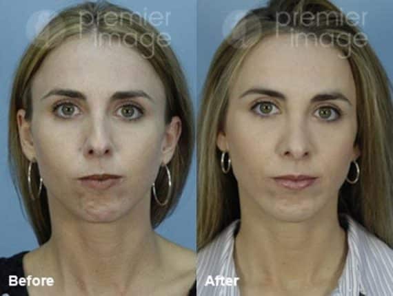 Rhinoplasty Before and after photos in Sandy Springs, GA, Patient 16005