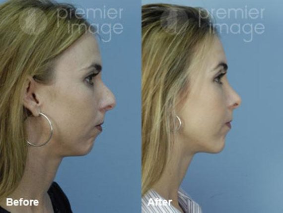 Rhinoplasty Before and after photos in Sandy Springs, GA, Patient 16005