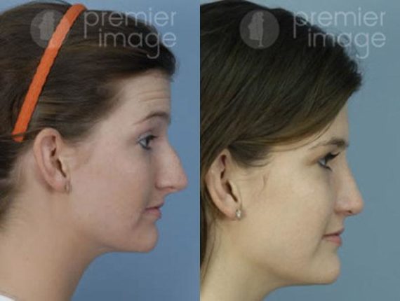 Rhinoplasty Before and after photos in Sandy Springs, GA, Patient 16012