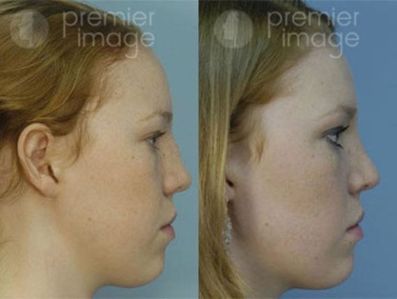 Rhinoplasty Before and after photos in Sandy Springs, GA, Patient 16015