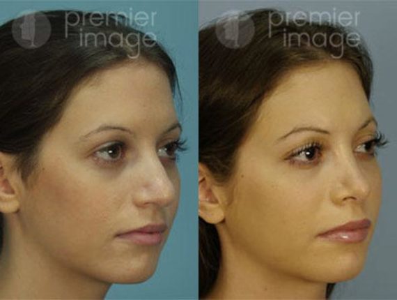 Rhinoplasty Before and after photos in Sandy Springs, GA, Patient 16018