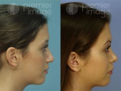 Rhinoplasty Before and after photos in Sandy Springs, GA, Patient 16018