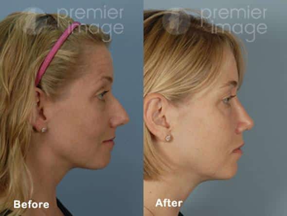 Rhinoplasty Before and after photos in Sandy Springs, GA, Patient 16045