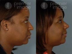 Rhinoplasty Before and after photos in Sandy Springs, GA, Patient 16052