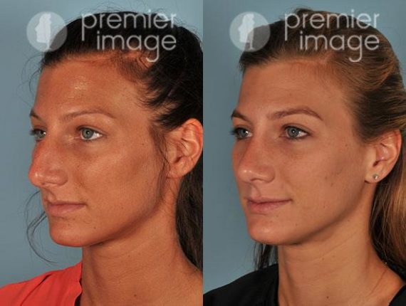 Rhinoplasty Before and after photos in Sandy Springs, GA, Patient 16059