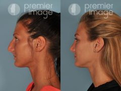 Rhinoplasty Before and after photos in Sandy Springs, GA, Patient 16059