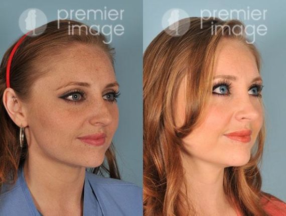 Rhinoplasty Before and after photos in Sandy Springs, GA, Patient 16066