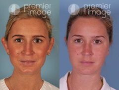 Otoplasty Before and after photos in Sandy Springs, GA, Patient 16084