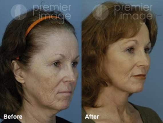 QT Mini-Facelift Before and after photos in Sandy Springs, GA, Patient 16123