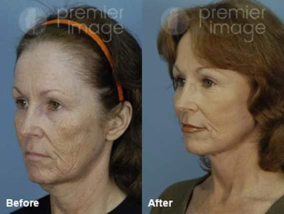 QT Mini-Facelift Before and after photos in Sandy Springs, GA, Patient 16123