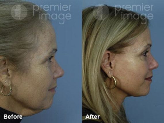 QT Mini-Facelift Before and after photos in Sandy Springs, GA, Patient 16128